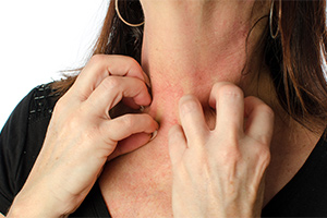 Chronic Hives Treatment Chronic Hives Treatment