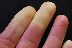 Ease Raynauds Disease Ease Raynauds Disease